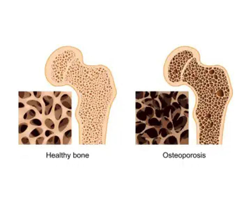 Osteoporosis - JK Physio And Rehab Clinics